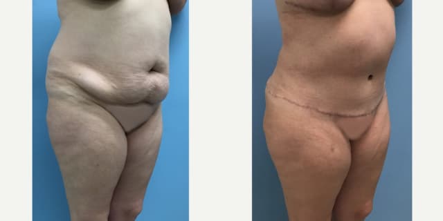 Mommy Makeover procedure image