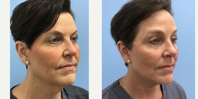 Facelift procedure image