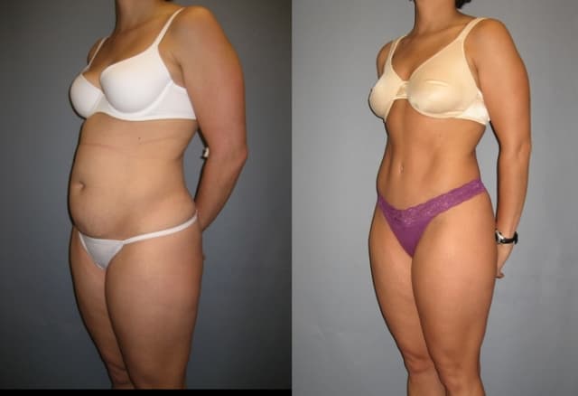 Tummy Tuck (Abdominoplasty) procedure image