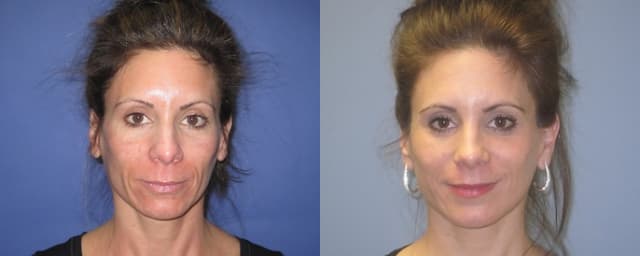 Facelift procedure image
