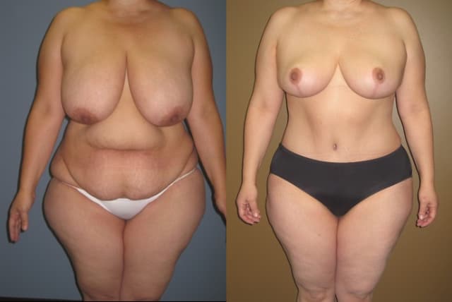 Tummy Tuck (Abdominoplasty) procedure image
