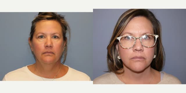 Facelift procedure image