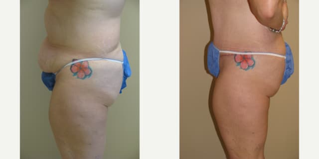 Skin Tightening procedure image