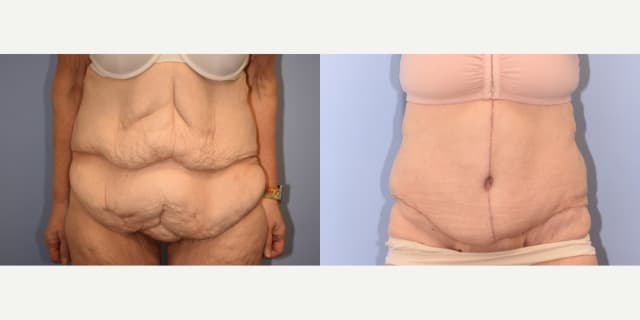 Tummy Tuck (Abdominoplasty) procedure image