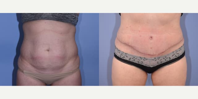 Mommy Makeover procedure image