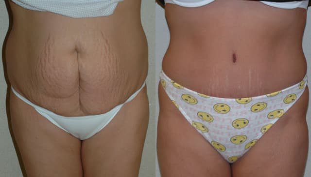 Tummy Tuck (Abdominoplasty) procedure image