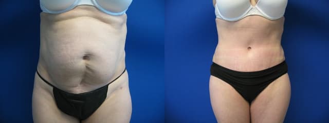 Mommy Makeover procedure image