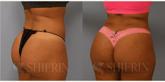 Brazilian Butt Lift (BBL) procedure image