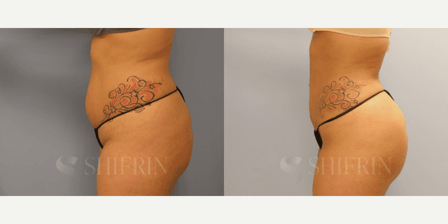 Hip Enhancement procedure image