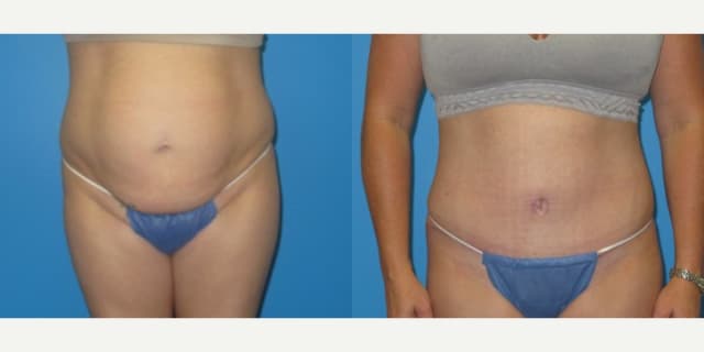 Tummy Tuck (Abdominoplasty) procedure image
