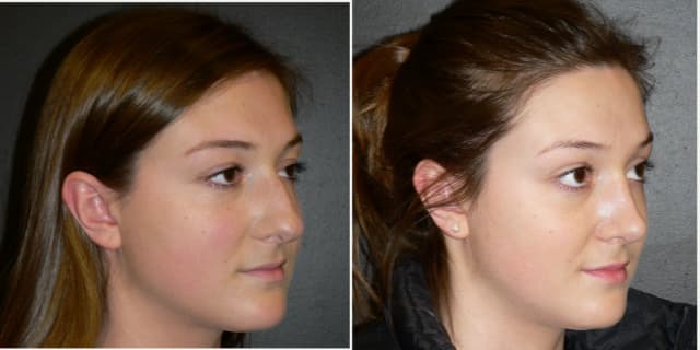 Eyelid Surgery (Blepharoplasty) procedure image