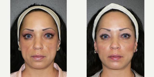 Rhinoplasty (Nose Job) procedure image