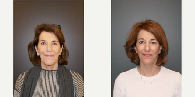 Facelift procedure image