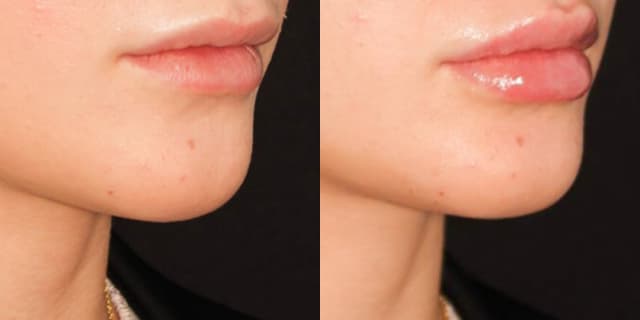 Fillers & Injectables (e.g. Botox, Juvederm) procedure image