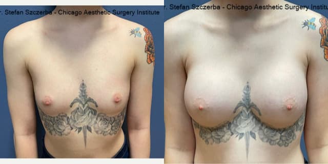 Breast Augmentation procedure image