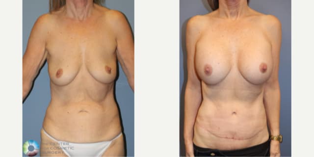 Mommy Makeover procedure image