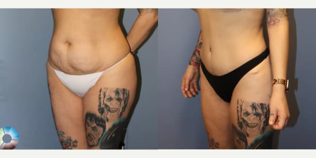 Tummy Tuck (Abdominoplasty) procedure image