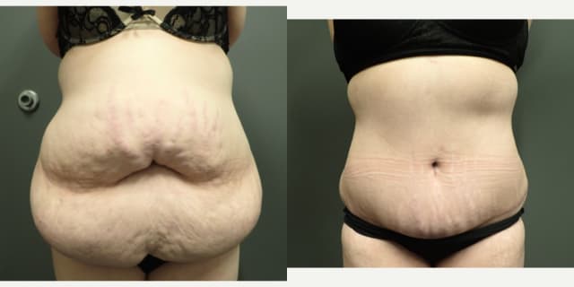 Tummy Tuck (Abdominoplasty) procedure image