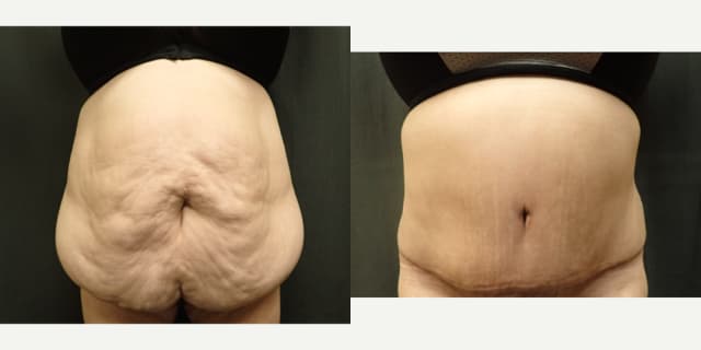 Mommy Makeover procedure image