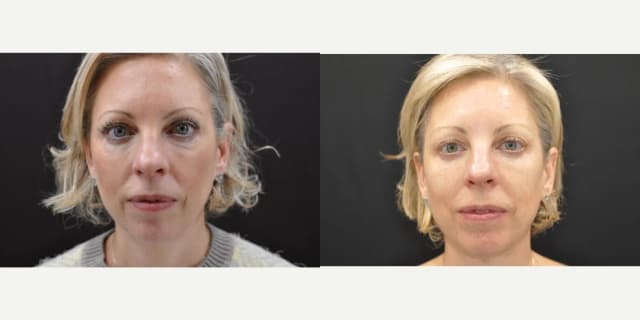 Eyelid Surgery (Blepharoplasty) procedure image