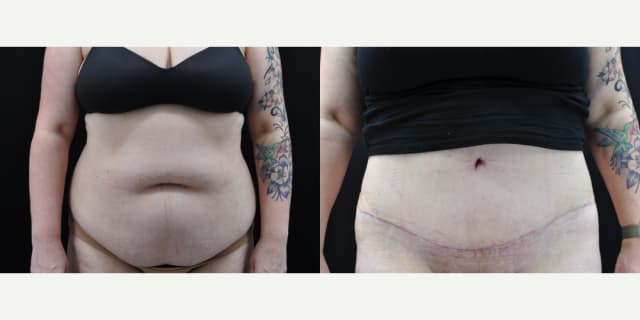 Liposuction procedure image