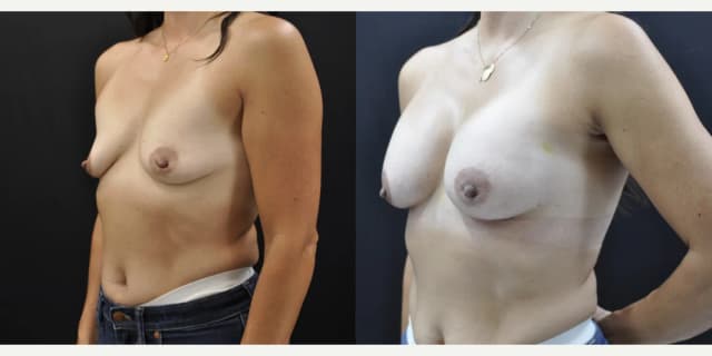 Mommy Makeover procedure image