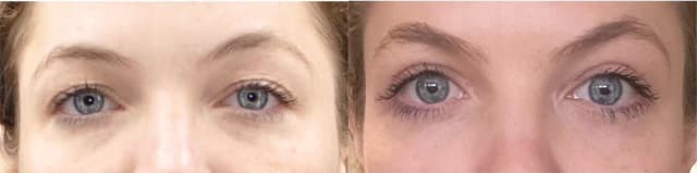 Eyelid Surgery (Blepharoplasty) procedure image