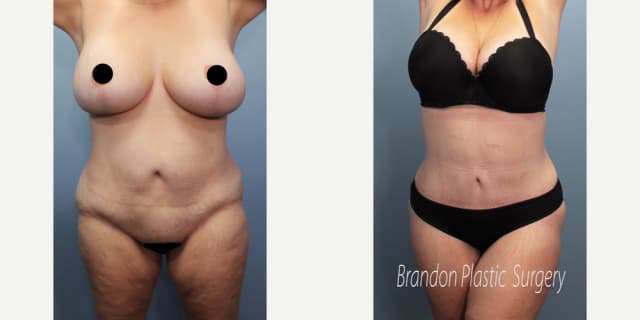 Tummy Tuck (Abdominoplasty) procedure image