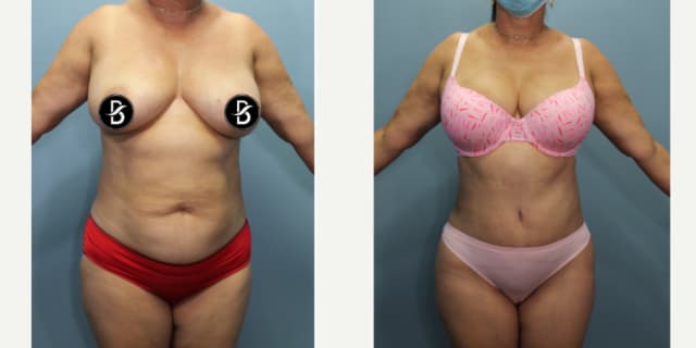 Mommy Makeover procedure image