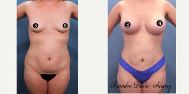 Breast Augmentation procedure image