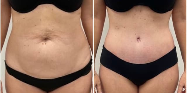 Tummy Tuck (Abdominoplasty) procedure image