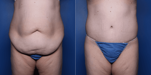 Tummy Tuck (Abdominoplasty) procedure image