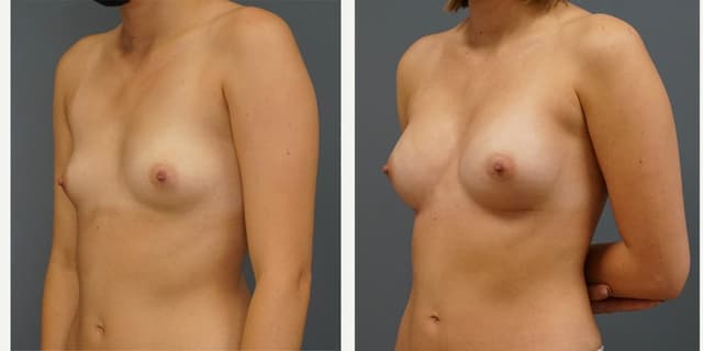 Mommy Makeover procedure image