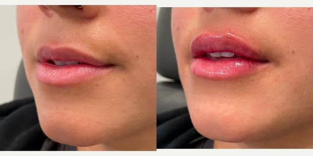 Lip Enhancement (Fillers) procedure image