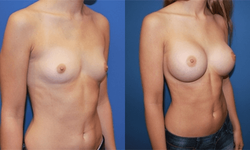 Mommy Makeover procedure image