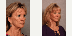 Facelift procedure image