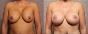 Breast Augmentation procedure image