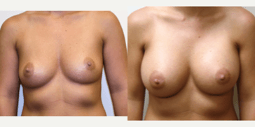 Breast Augmentation procedure image
