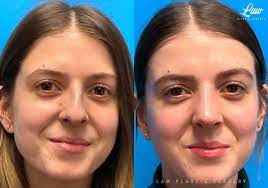 Rhinoplasty (Nose Job) procedure image
