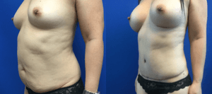 Skin Tightening procedure image