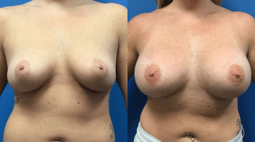 Breast Augmentation procedure image