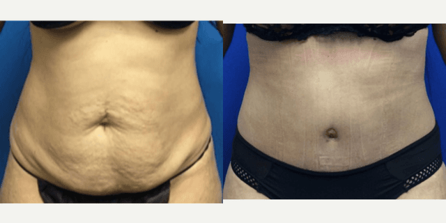 Mommy Makeover procedure image