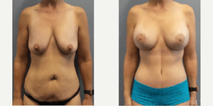 Mommy Makeover procedure image