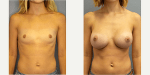 Breast Augmentation procedure image