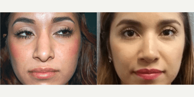 Rhinoplasty (Nose Job) procedure image