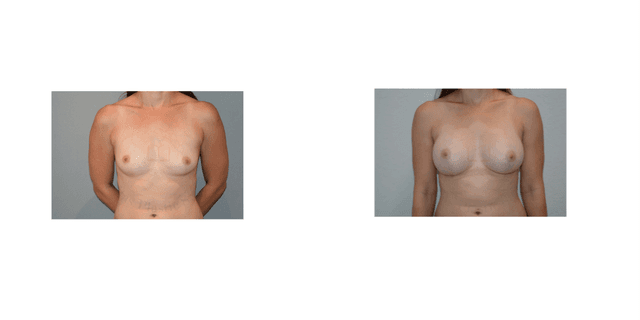 Breast Augmentation procedure image