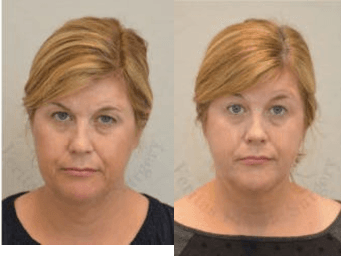 Facelift procedure image