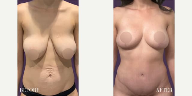 Mommy Makeover procedure image