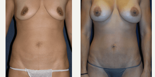 Breast Augmentation procedure image