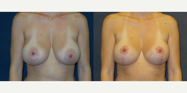 Mommy Makeover procedure image